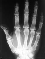 /album/calcifica%c3%a7%c3%a3o%20vascular/calcificacao-i-png1/